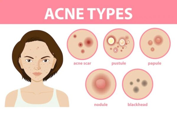 पिंपल्स/मुहांसे के कारण, लक्षण, परहेज और घरेलू उपाय Pimples/Acne symptoms and remedies in Hindi
