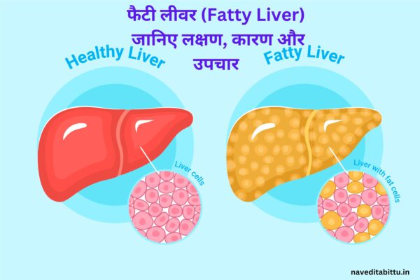 फैटी लीवर (Fatty Liver) लक्षण, कारण और उपचार